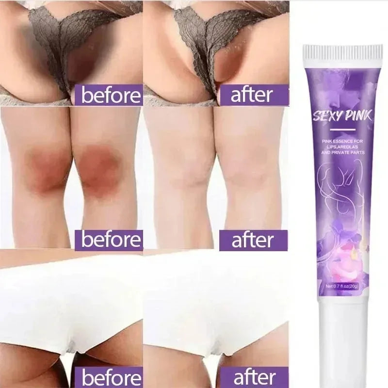 Whitening Cream Private Parts Underarm Bleaching Whiten Butt Knee Brighten Inner Thigh Intimate Parts Dark Remove Melanin